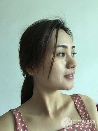 松原齊飛整形割雙眼皮真人案例前后對(duì)比圖日扎分享