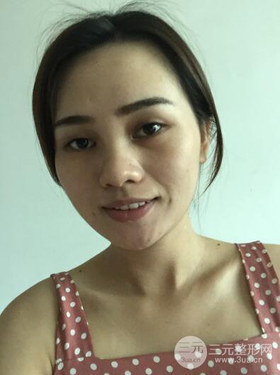 松原齊飛整形割雙眼皮真人案例前后對(duì)比圖日扎分享