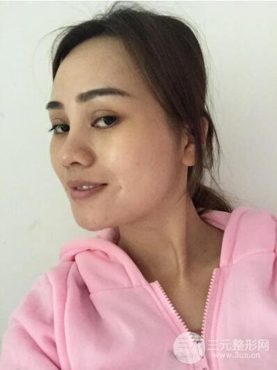 松原齊飛整形割雙眼皮真人案例前后對(duì)比圖日扎分享