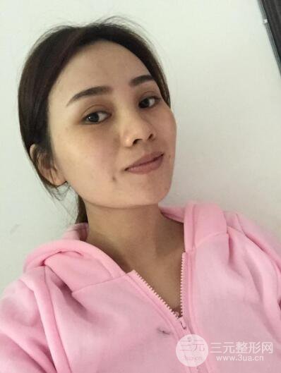 松原齊飛整形割雙眼皮真人案例前后對(duì)比圖日扎分享