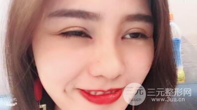 松原齊飛整形割雙眼皮真人案例前后對(duì)比圖日扎分享