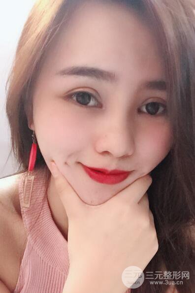 松原齊飛整形割雙眼皮真人案例前后對(duì)比圖日扎分享