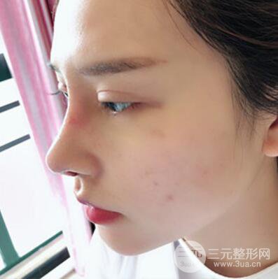 哈爾濱哈美萊鄭東學隆鼻整形案例對比圖真實心情分享喲~