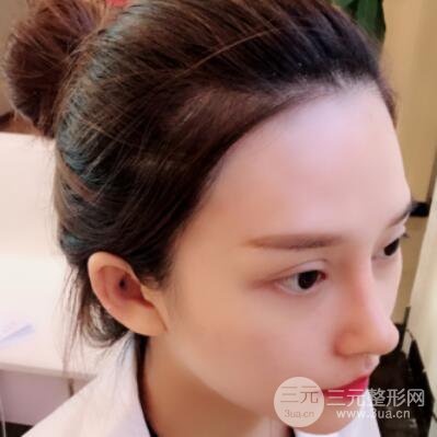 哈爾濱哈美萊鄭東學隆鼻整形案例對比圖真實心情分享喲~