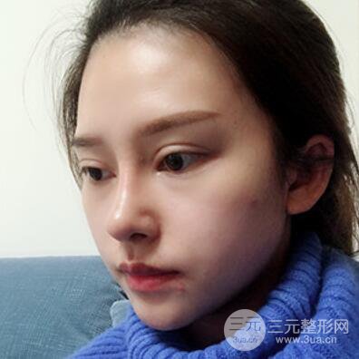 哈爾濱哈美萊鄭東學隆鼻整形案例對比圖真實心情分享喲~