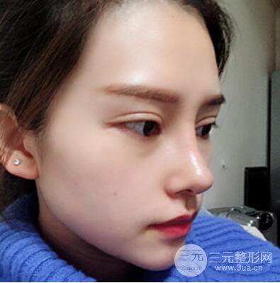 哈爾濱哈美萊鄭東學隆鼻整形案例對比圖真實心情分享喲~