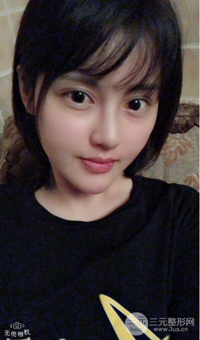 常州施爾美廉鋒自體脂肪豐臉對照圖案例心情日扎