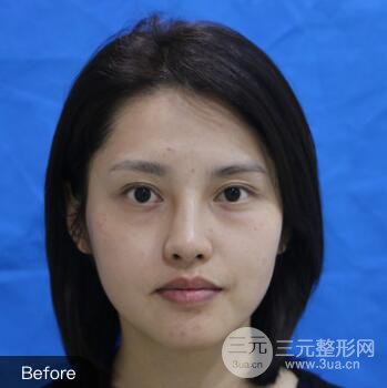 常州施爾美廉鋒自體脂肪豐臉對照圖案例心情日扎