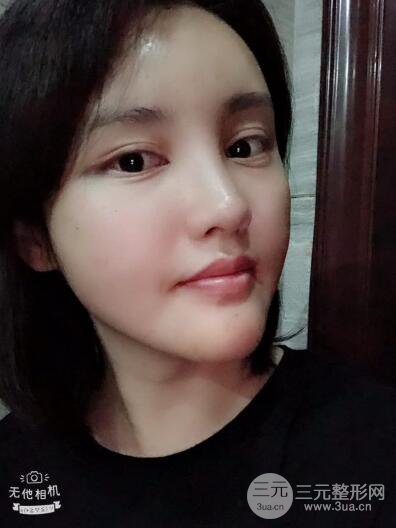 常州施爾美廉鋒自體脂肪豐臉對照圖案例心情日扎