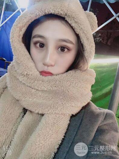 貴陽麗都李觀龍隆鼻整形案例對照圖一個(gè)月恢復(fù)過程分享