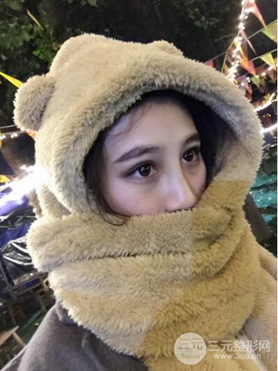 貴陽麗都李觀龍隆鼻整形案例對照圖一個(gè)月恢復(fù)過程分享