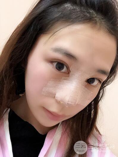 貴陽麗都李觀龍隆鼻整形案例對照圖一個(gè)月恢復(fù)過程分享