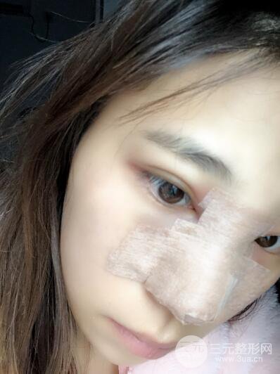 貴陽麗都李觀龍隆鼻整形案例對照圖一個(gè)月恢復(fù)過程分享