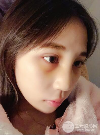 貴陽麗都李觀龍隆鼻整形案例對照圖一個(gè)月恢復(fù)過程分享