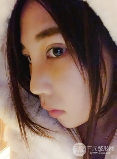 貴陽麗都李觀龍隆鼻整形案例對照圖一個(gè)月恢復(fù)過程分享