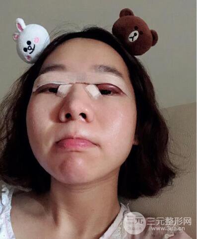湘潭華美切開雙眼皮案例對照圖兩個(gè)月恢復(fù)過程心情日扎