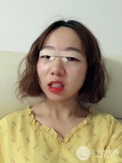 湘潭華美切開雙眼皮案例對照圖兩個(gè)月恢復(fù)過程心情日扎