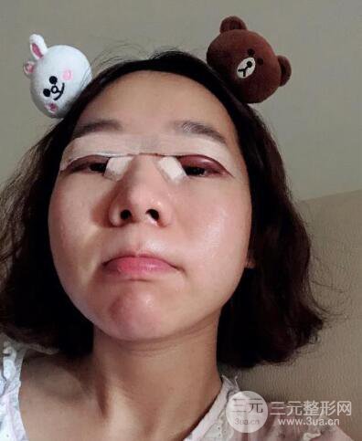 湘潭華美切開雙眼皮案例對照圖兩個(gè)月恢復(fù)過程心情日扎