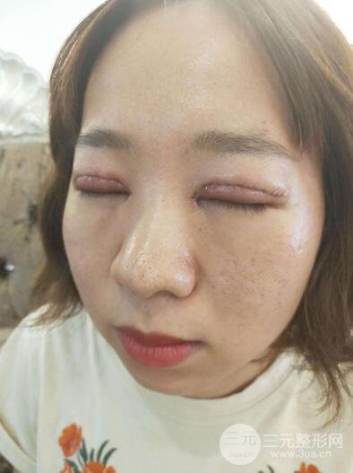 湘潭華美切開雙眼皮案例對照圖兩個(gè)月恢復(fù)過程心情日扎