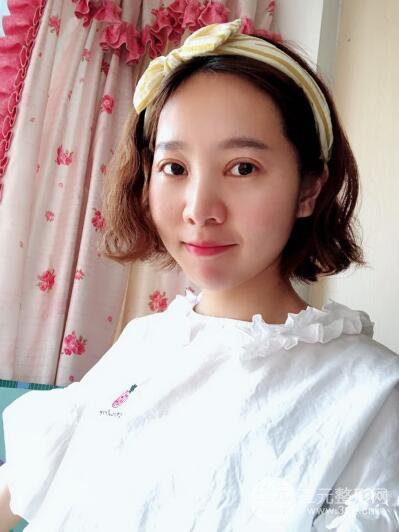 湘潭華美切開雙眼皮案例對照圖兩個(gè)月恢復(fù)過程心情日扎