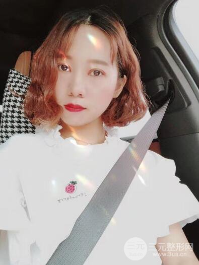 湘潭華美切開雙眼皮案例對照圖兩個(gè)月恢復(fù)過程心情日扎