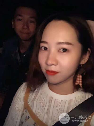 湘潭華美切開雙眼皮案例對照圖兩個(gè)月恢復(fù)過程心情日扎