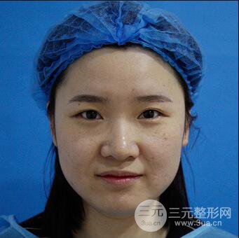 貴陽(yáng)美萊梁潔芭比媚雙眼皮多項(xiàng)整形前后對(duì)比圖恢復(fù)心情小札