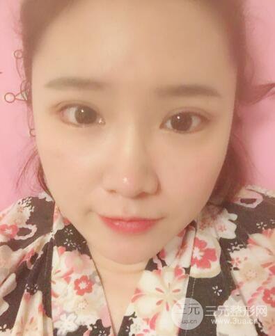 貴陽(yáng)美萊梁潔芭比媚雙眼皮多項(xiàng)整形前后對(duì)比圖恢復(fù)心情小札