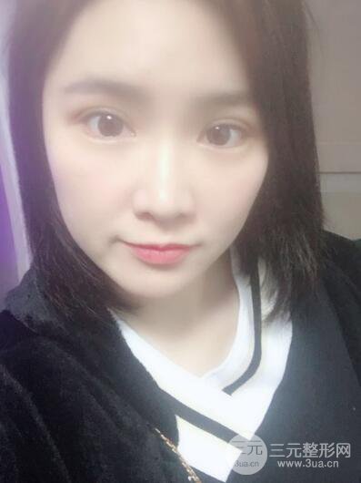 貴陽(yáng)美萊梁潔芭比媚雙眼皮多項(xiàng)整形前后對(duì)比圖恢復(fù)心情小札