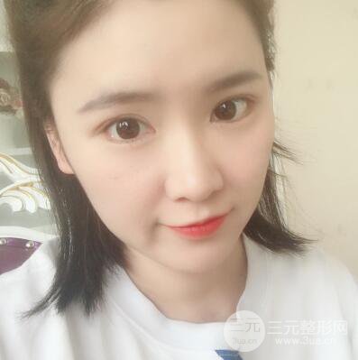 貴陽(yáng)美萊梁潔芭比媚雙眼皮多項(xiàng)整形前后對(duì)比圖恢復(fù)心情小札