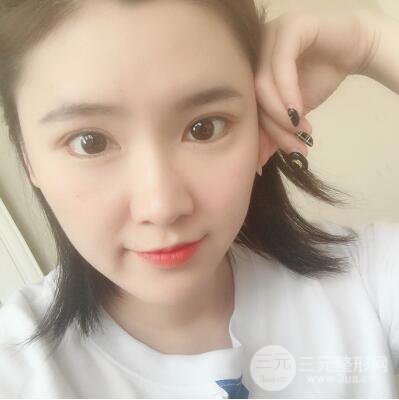 貴陽(yáng)美萊梁潔芭比媚雙眼皮多項(xiàng)整形前后對(duì)比圖恢復(fù)心情小札