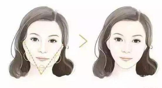 玻尿酸墊下巴有危害嗎