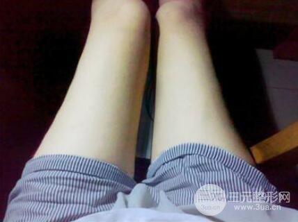 注射注射瘦腿反彈會更粗嗎