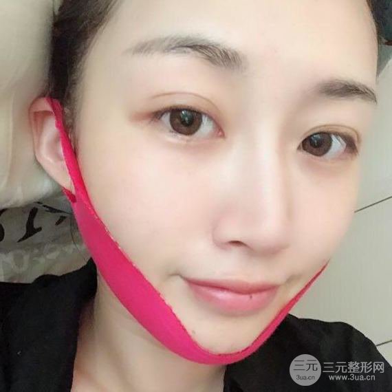 【術(shù)后3天即可上妝】大V.線 定點(diǎn)提拉 讓臉“嘭嘭嘭”！