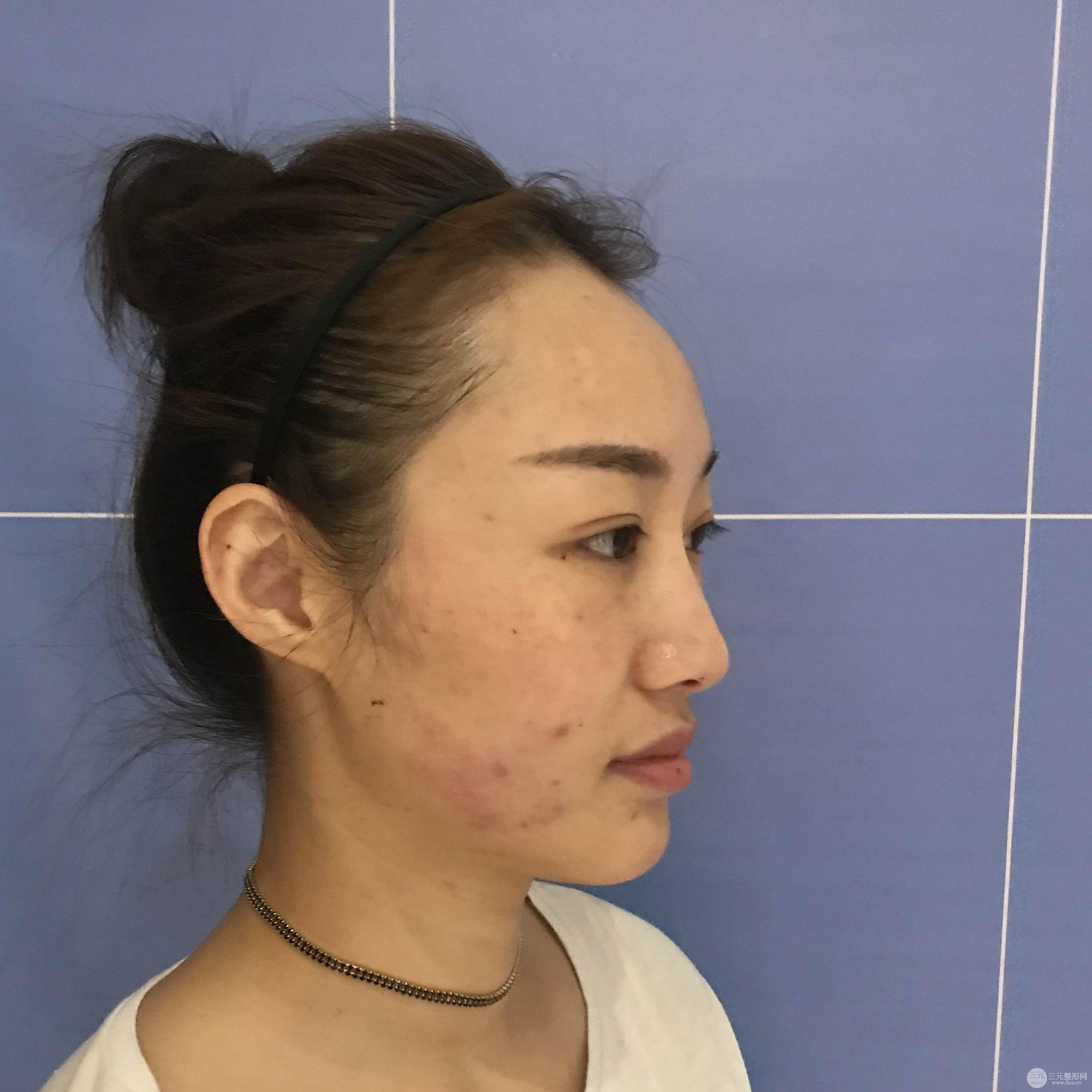 【術(shù)后3天即可上妝】大V.線 定點(diǎn)提拉 讓臉“嘭嘭嘭”！