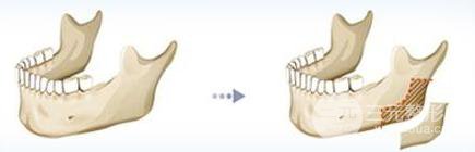 下頜角磨骨術(shù)恢復(fù)期要怎么保養(yǎng)、術(shù)后護(hù)理？