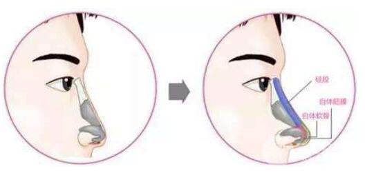 鼻中隔軟骨隆鼻有沒有什么后遺癥?有后遺癥嗎?