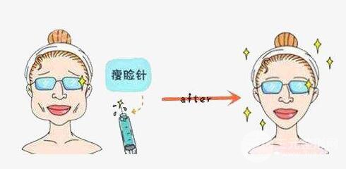 注射注射瘦臉瘦臉的副作用嚴(yán)重嗎？需要注意什么