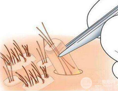 植發(fā)有后遺癥嗎?植發(fā)后遺癥有哪些?