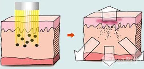 做光子嫩膚后紅臉是正常的嗎？多久恢復(fù)？