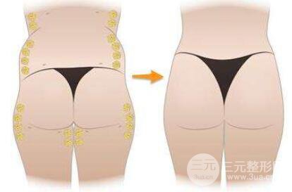玻尿酸豐臀靠譜嗎?玻尿酸豐臀如何做好護(hù)理工作?