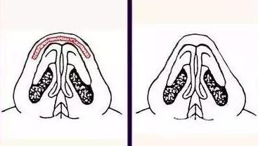 膨體材料隆鼻需要多少錢？價格影響有哪些？