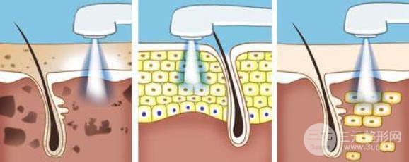 什么是ipl光子嫩膚？原理是什么？