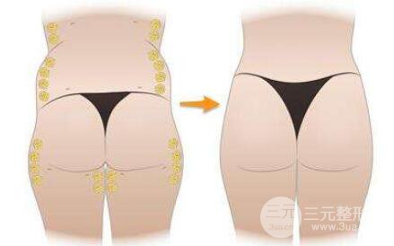 玻尿酸豐臀成好嗎?可以維持多久?