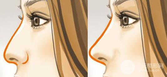 成都蜀尚蓉雅做假體隆鼻多少錢？價格影響有？