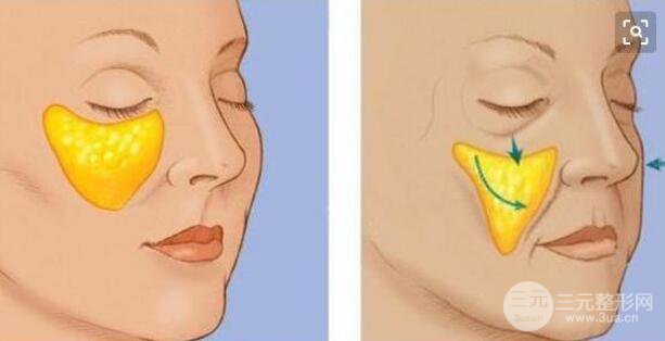 活體脂肪填充出現(xiàn)回縮情況需要補填嗎?