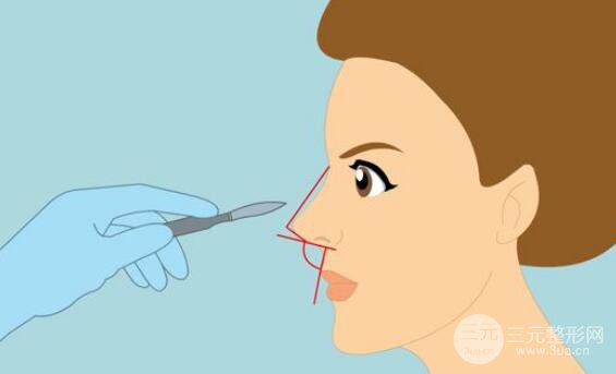 成都隆鼻整形手術(shù)多少錢?如何做好術(shù)后護理工作?