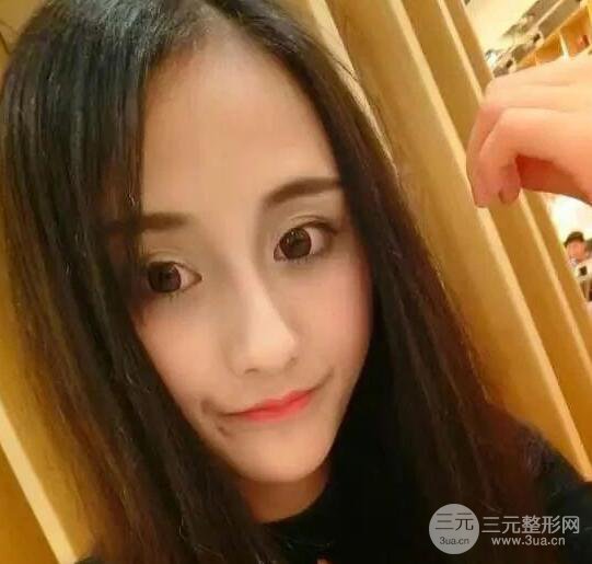 北京伊美爾何禎平做完雙眼皮