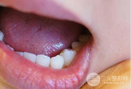 美容冠全瓷經(jīng)驗(yàn)