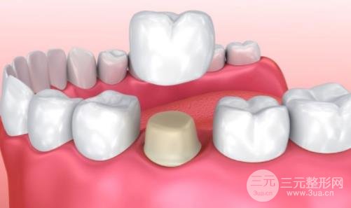 全瓷牙價(jià)格